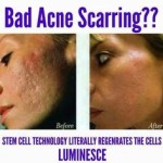 Luminesce for scar