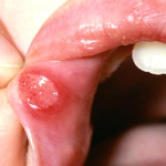mouth ulcer, cancer