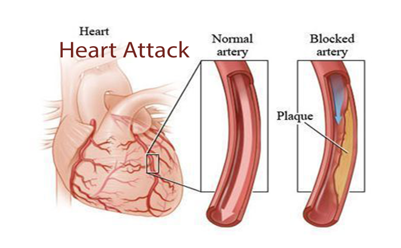 The Top Secret Diet Therapy Of Heart Attack Without Surgery